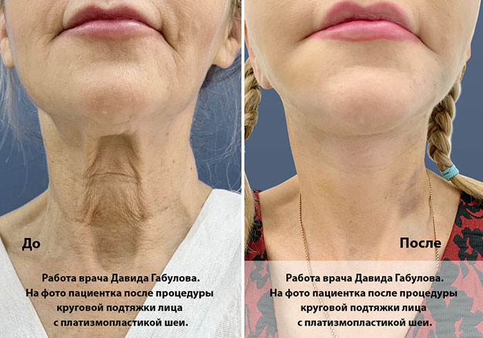 Круговая подтяжка лица с платизмопластикой шеи Круговая подтяжка лица с платизмопластикой шеи
