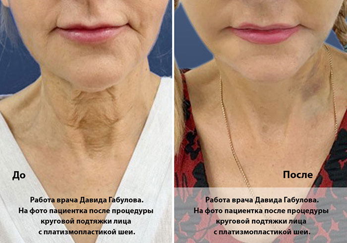 Круговая подтяжка лица с платизмопластикой шеи Круговая подтяжка лица с платизмопластикой шеи