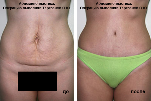 Абдоминопластика Абдоминопластика